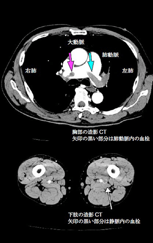 肺血栓塞栓症の胸部造影CTと下肢の造影CT