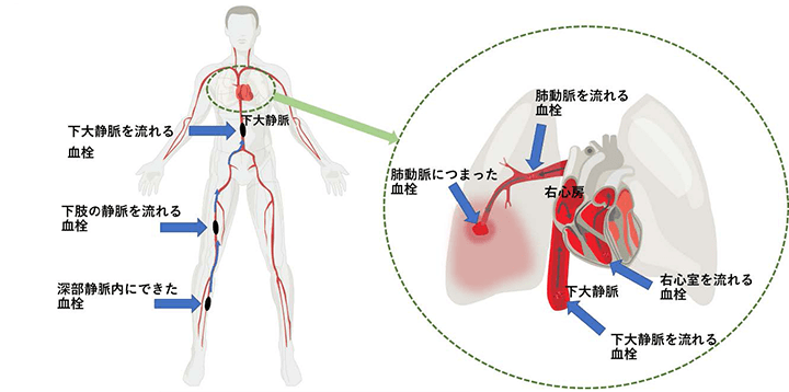 エコノミークラス症候群（肺血栓塞栓症）