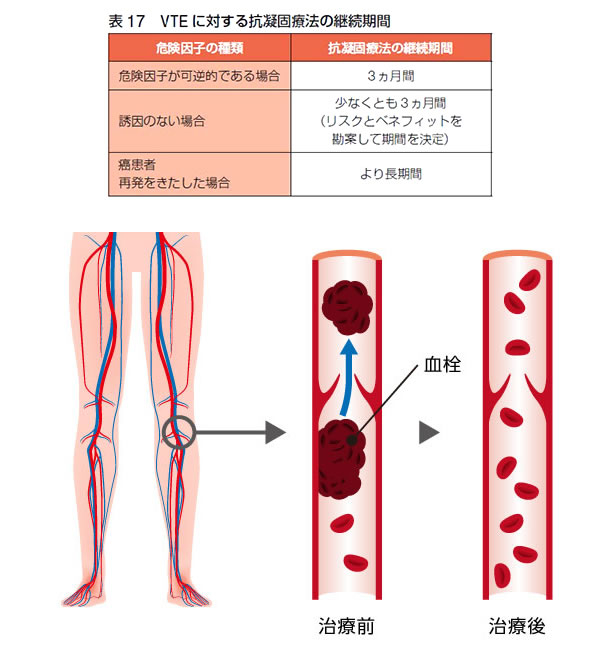 エコノミークラス症候群（肺血栓塞栓症）治療法　VTEに対する抗凝固療法の継続期間