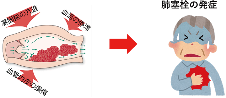 血栓ができる原因　肺塞栓の発症