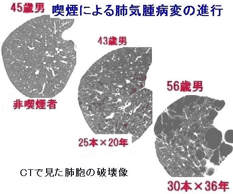 nosmoking_copd01.gif